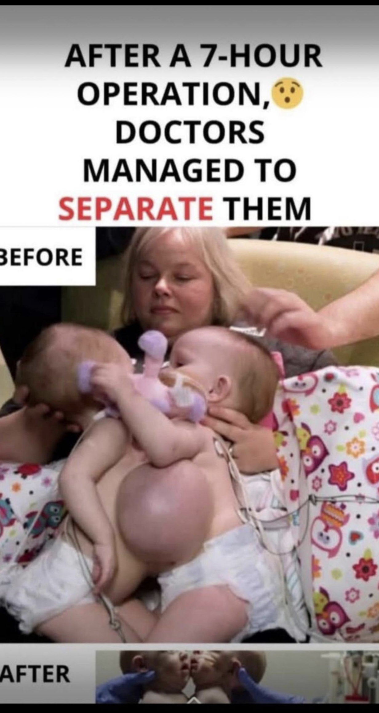 After a 7-hour operation, doctors managed to separate them”